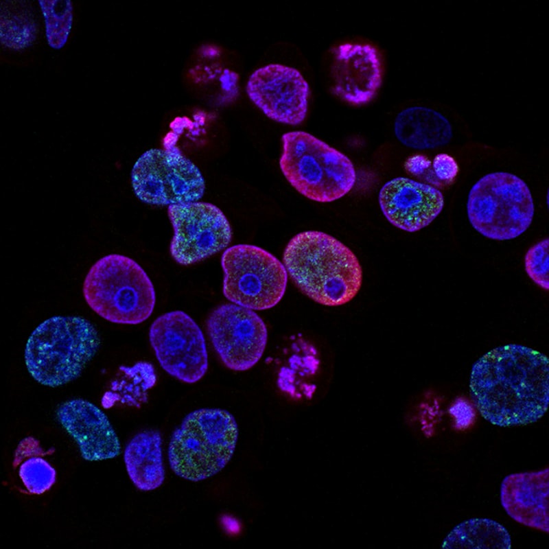 Cancer cells under fluorescent microscopy showing DNA damage markers